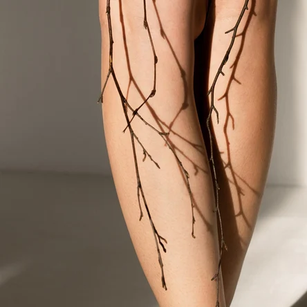 Склеротерапия